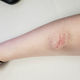 The day after Scruffy bit me!